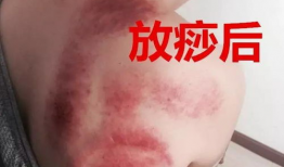 刮痧视频教程,跟随视频教程轻松掌握刮痧技巧